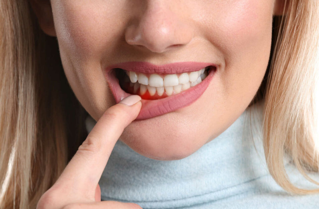 Woman pointing to her mouth and pulling down bottom lip to expose red inflamed gums.
