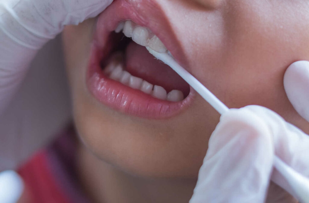 A close-up of a toddler's mouth and a hand of a dentist with latex gloves holding a cotton swab and applying fluoride on a boy's teeth.
