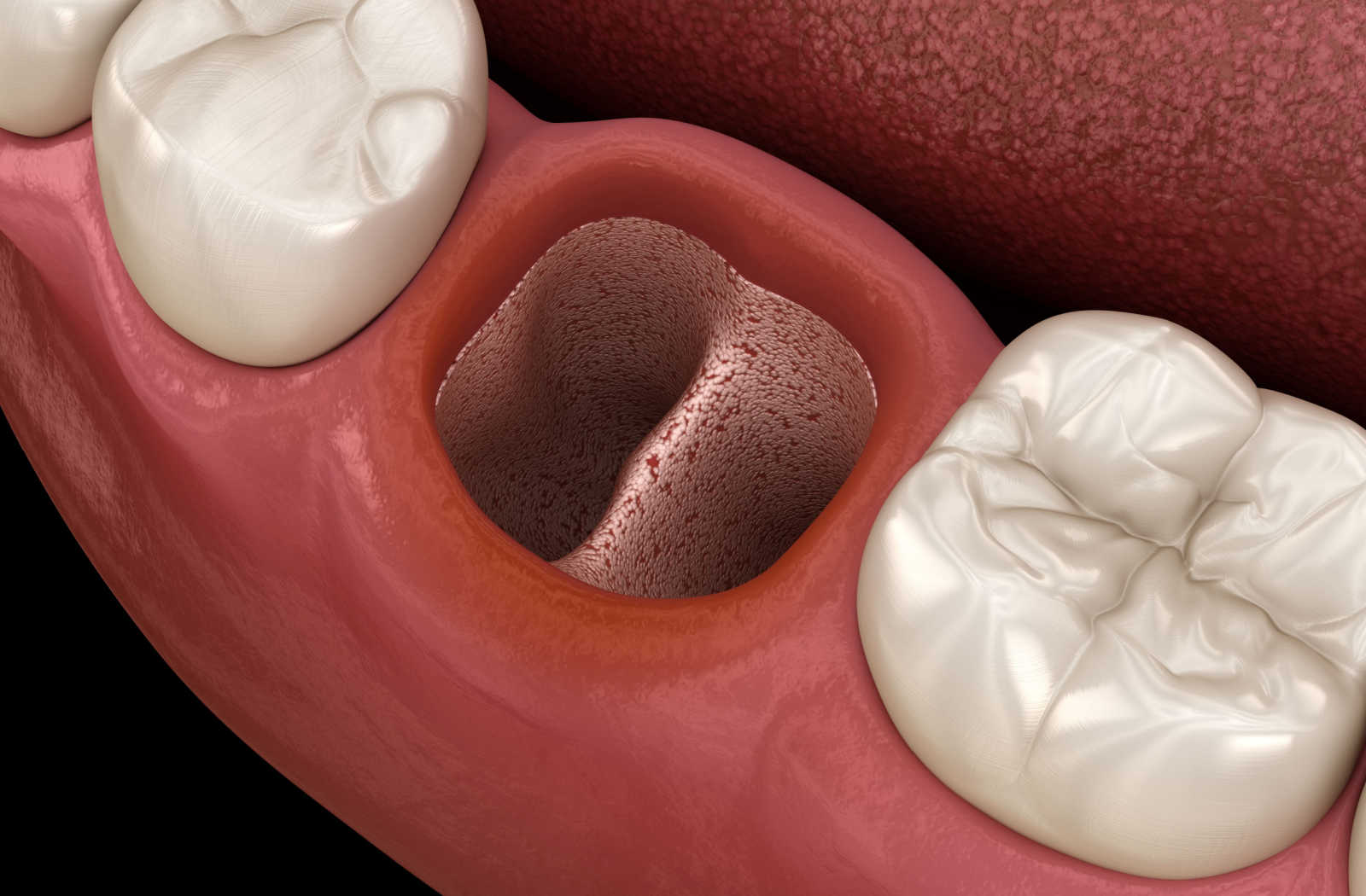 3D image of an open socket after tooth extraction.