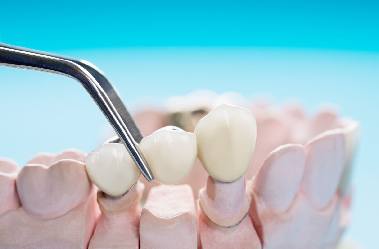 A close-up of prosthetic teeth, a crown, and a bridge used in prosthodontics.